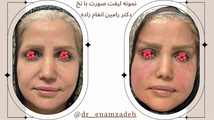 ماندگاری لیفت صورت با نخ
