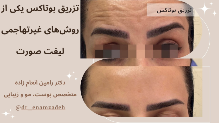 تزریق بوتاکس دکتر رامین انعام زاده